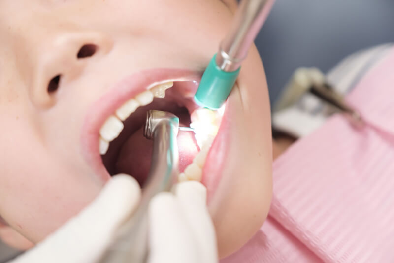 小児の虫歯の特徴