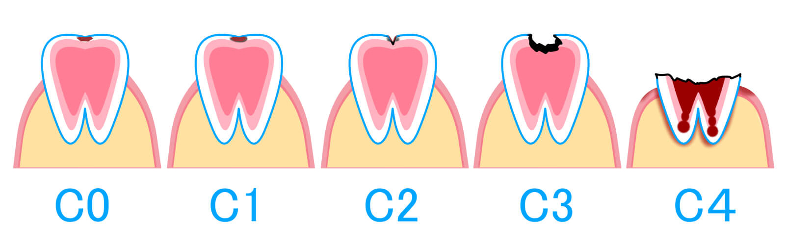 虫歯の進行度とおもな治療法